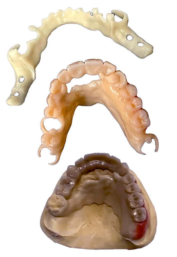 Pr贸tesis Parcial Removible con Esquel茅tico Flexible